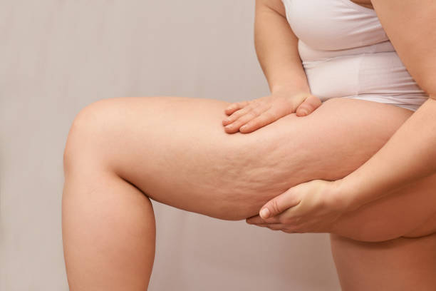 Terminate cellulite from the body