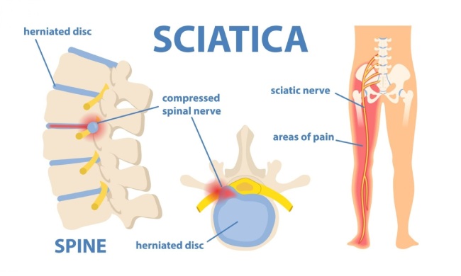 How does sciatica happen