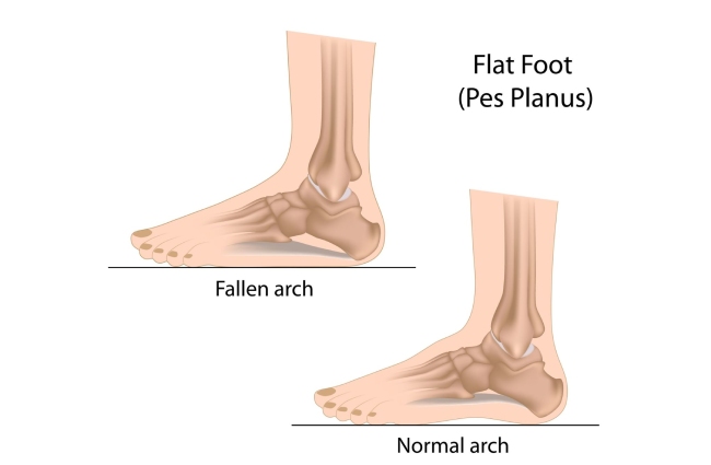 Reason to develop flat feet and ways to deal with it